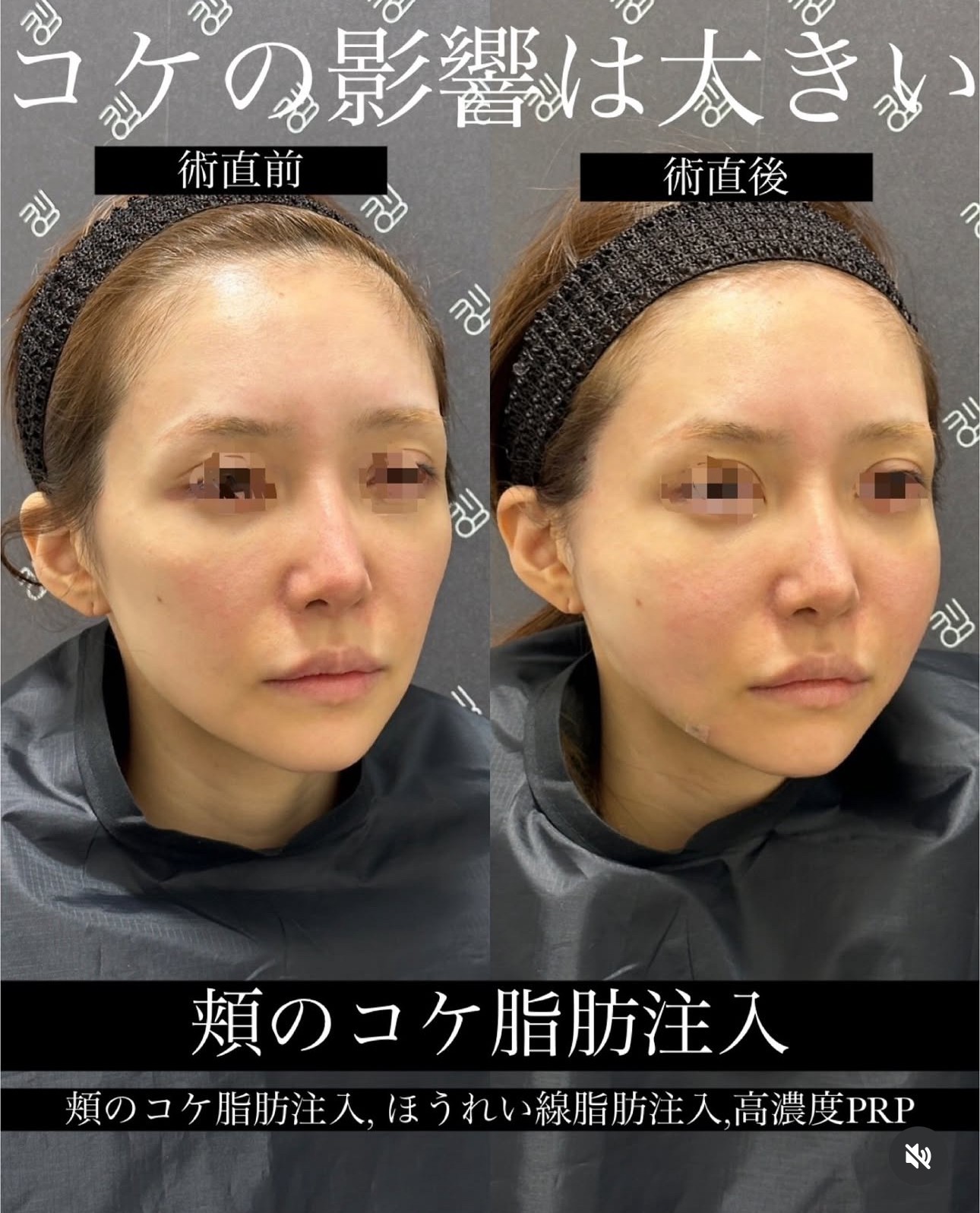 施術前後の頬と口元の比較