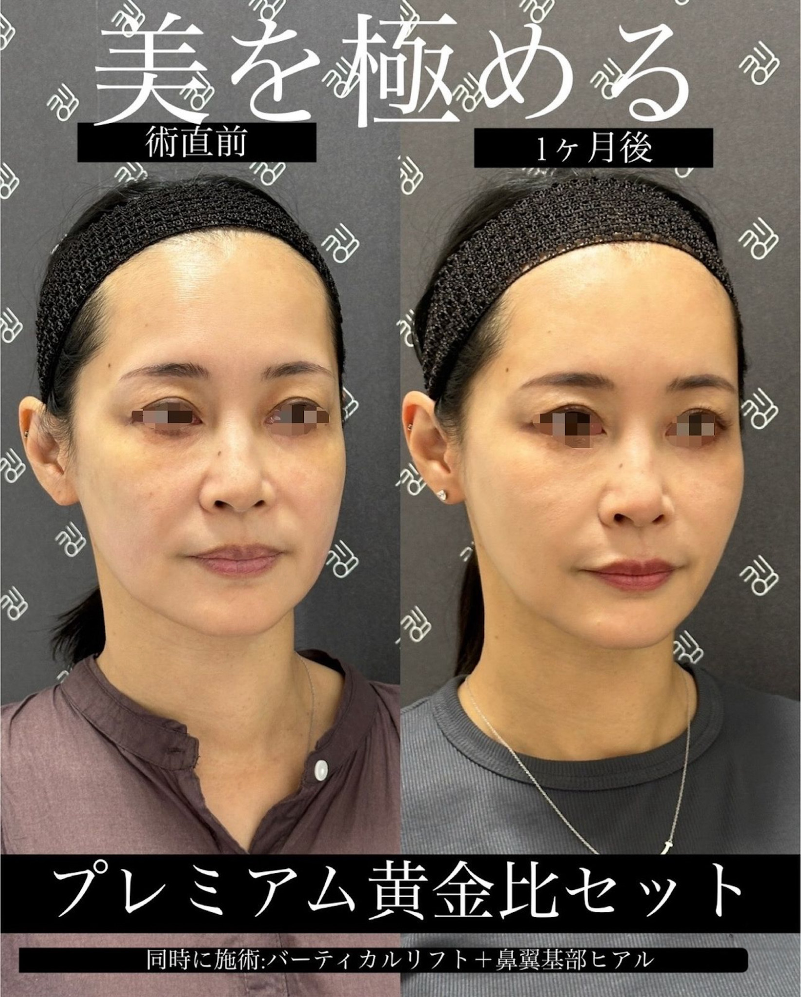 施術前後の女性の顔写真比較