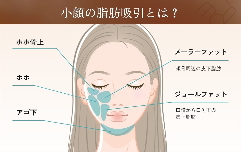 小顔脂肪吸引の施術部位を示すイラスト