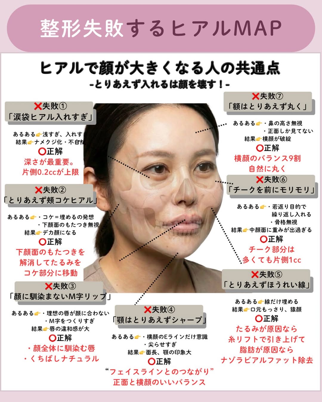 ヒアルロン酸注入による顔の整形失敗例とその改善策