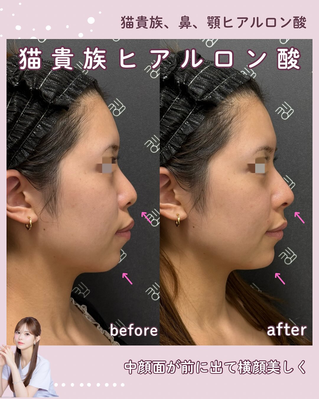 hyaluronic-acid-injection-before-after