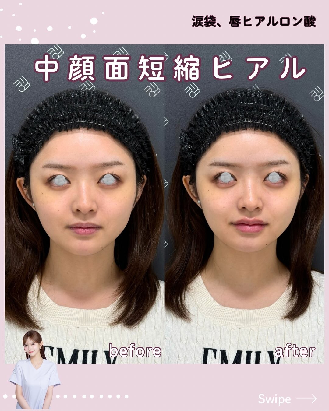 ヒアルロン酸注入のビフォーアフター