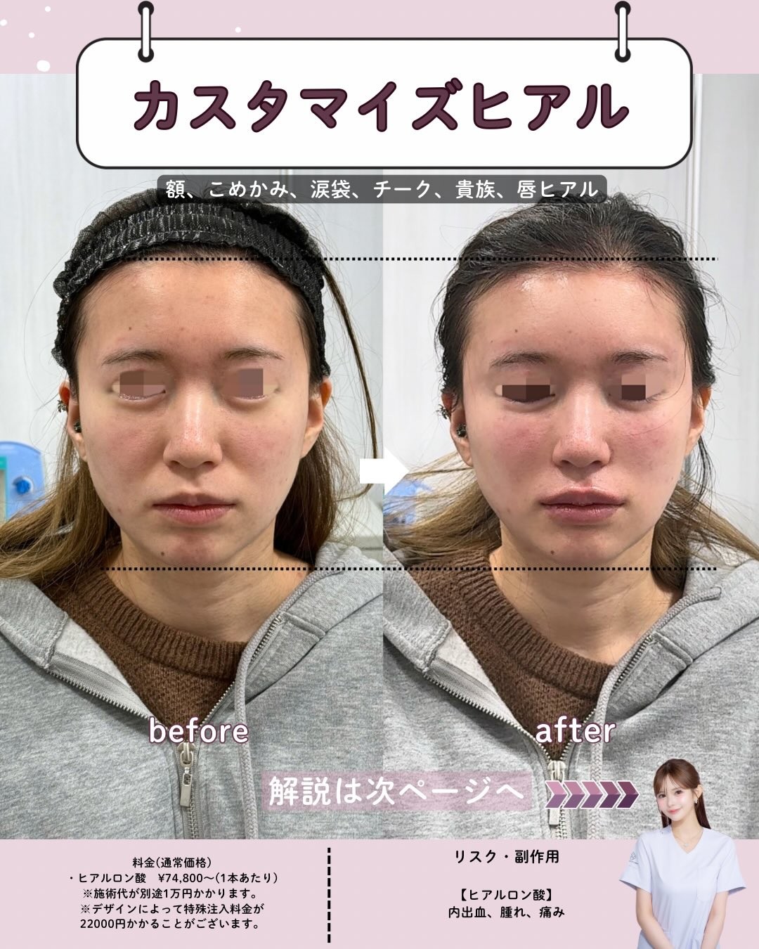 ヒアルロン酸施術前後の女性の顔比較