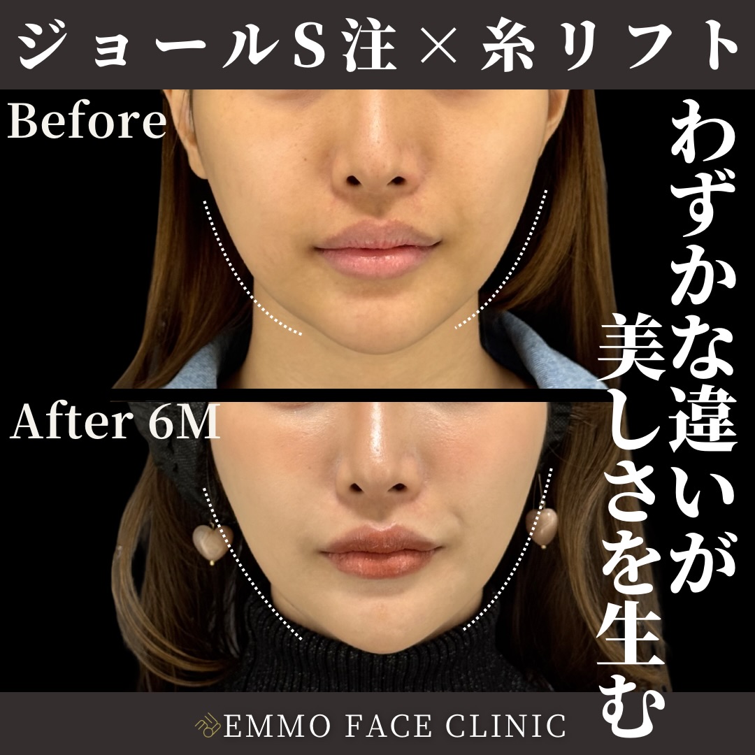 ジョールファット脂肪吸引×糸リフト