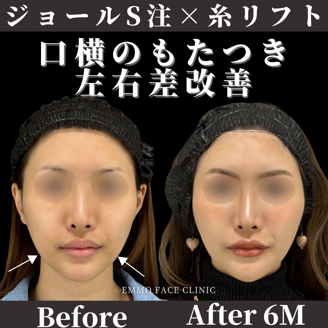 ジョールファット脂肪吸引×糸リフト
