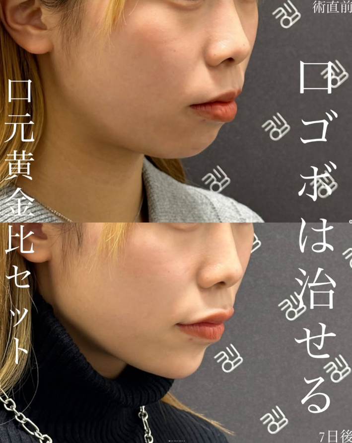 口元黄金比セットのビフォーアフター 02