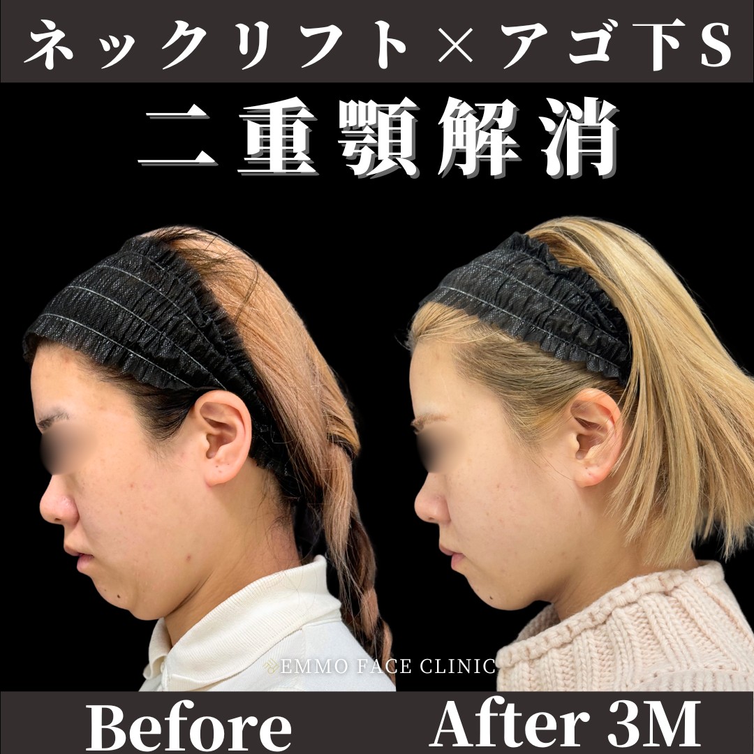 首と顎下の美容整形ビフォーアフター