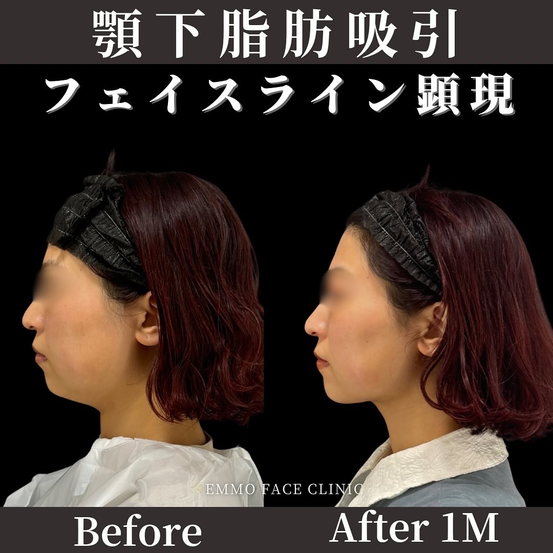 顎下脂肪吸引の術前と術後1ヶ月の比較