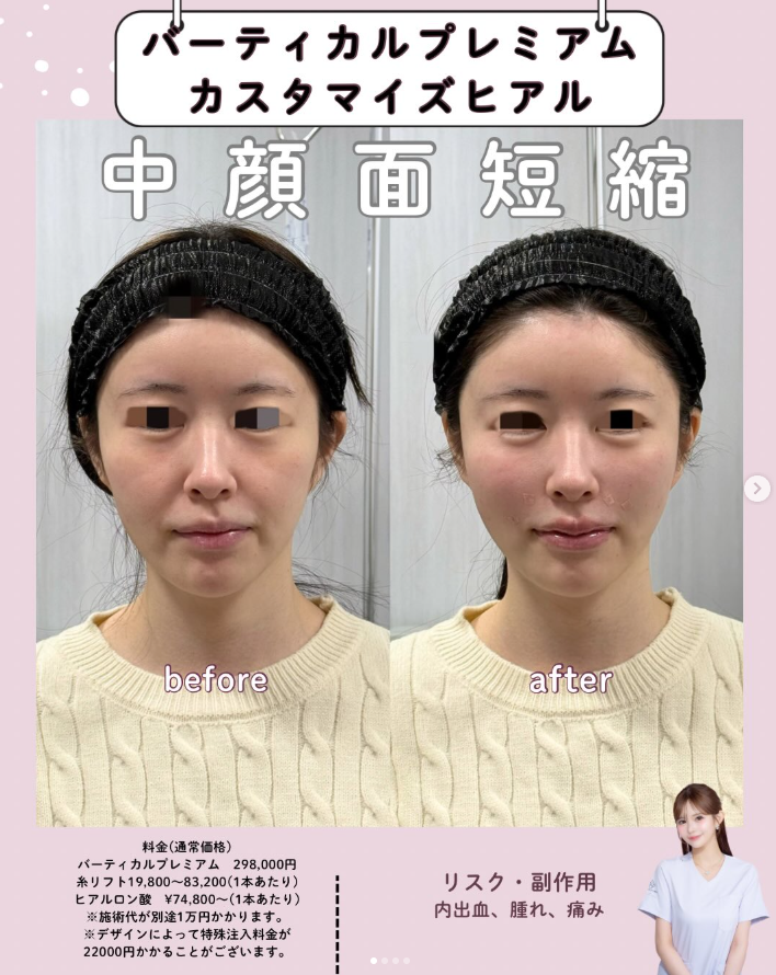 糸リフトとヒアルロン酸注入のビフォーアフター