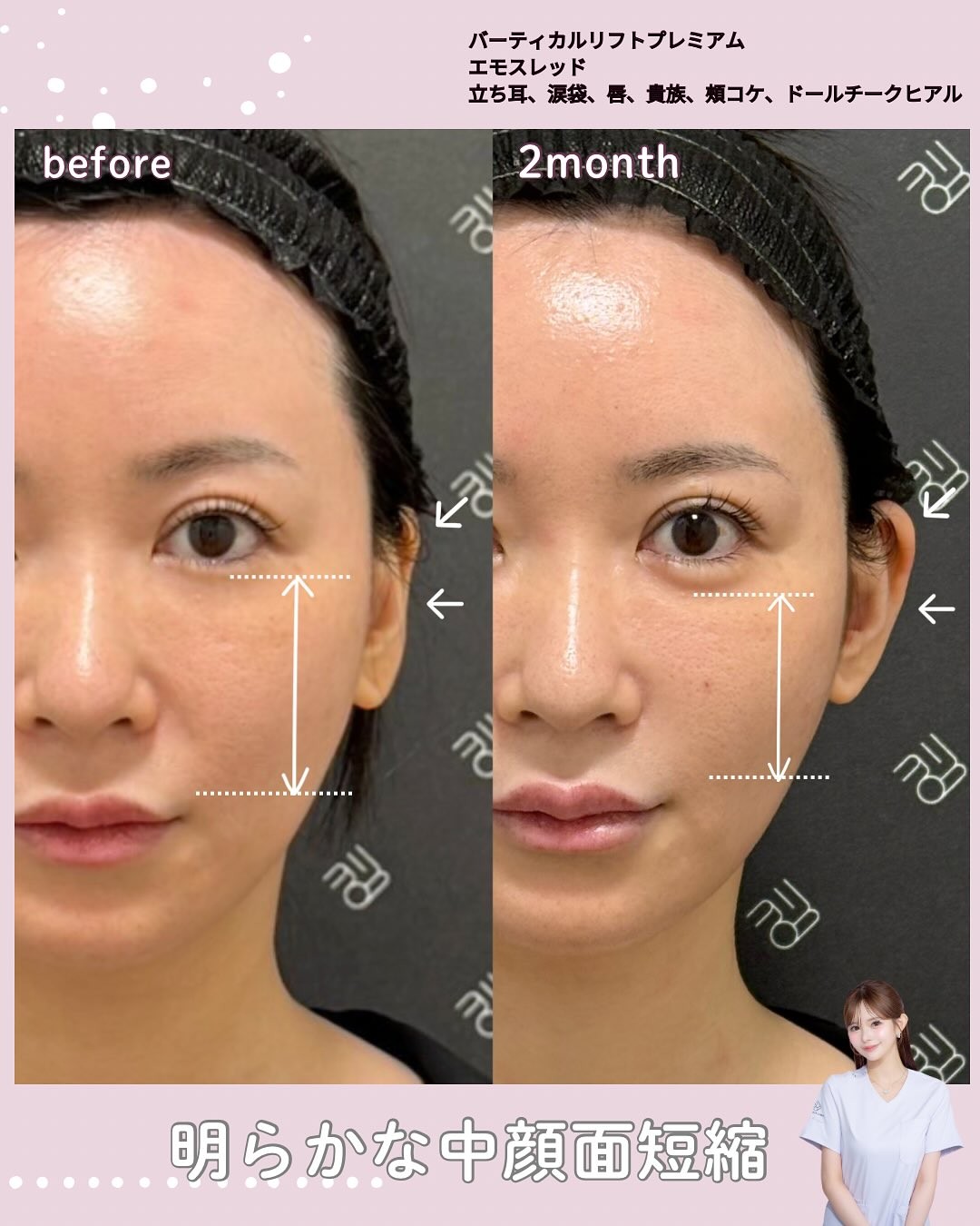 糸リフトとヒアルロン酸注入のビフォーアフター01