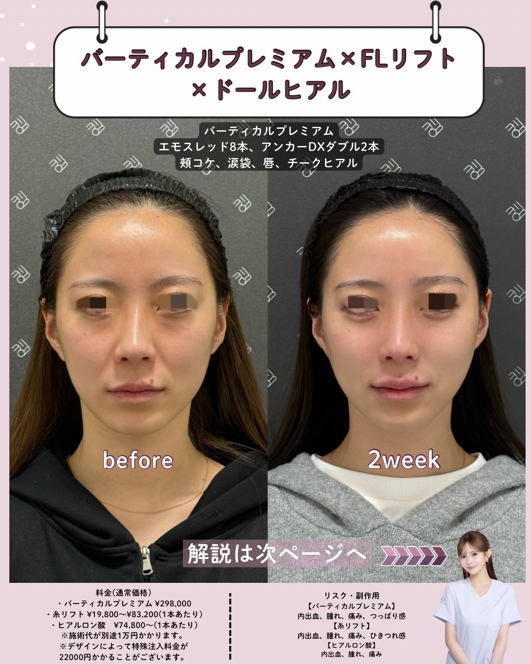 糸リフトとヒアルロン酸注入のビフォーアフター02