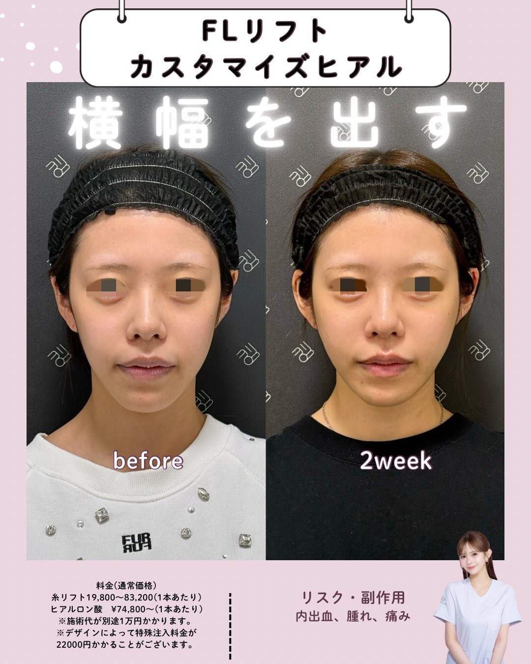 糸リフトとカスタマイズヒアルのビフォーアフター