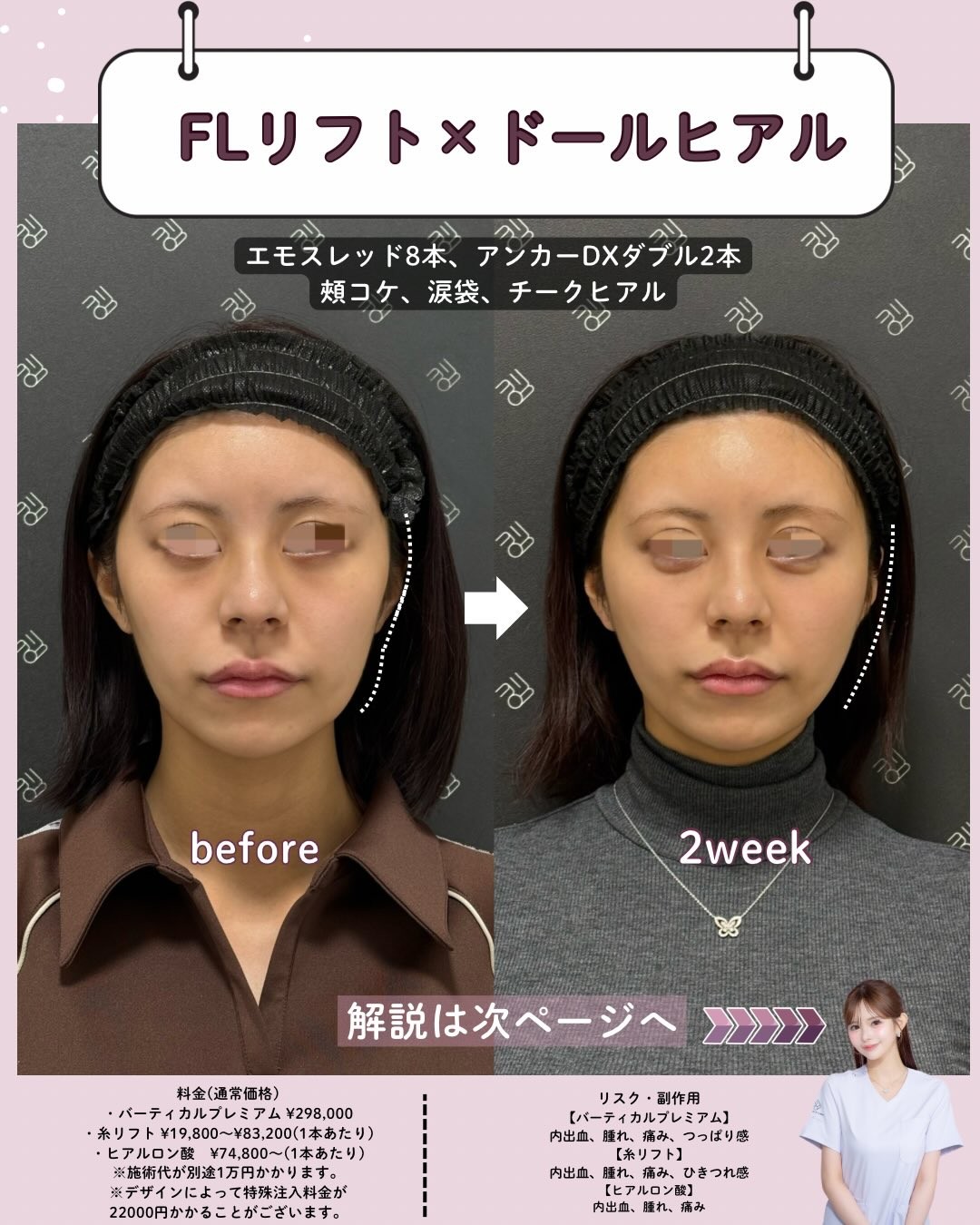 糸リフトとドールヒアルのビフォーアフター