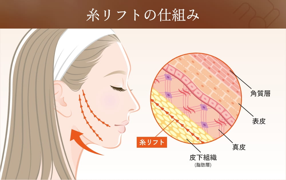 糸リフト施術の仕組みと皮膚組織の断面図