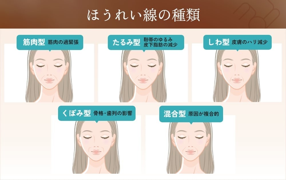 ほうれい線の種類とそれぞれの特徴を示す5つの顔のイラスト