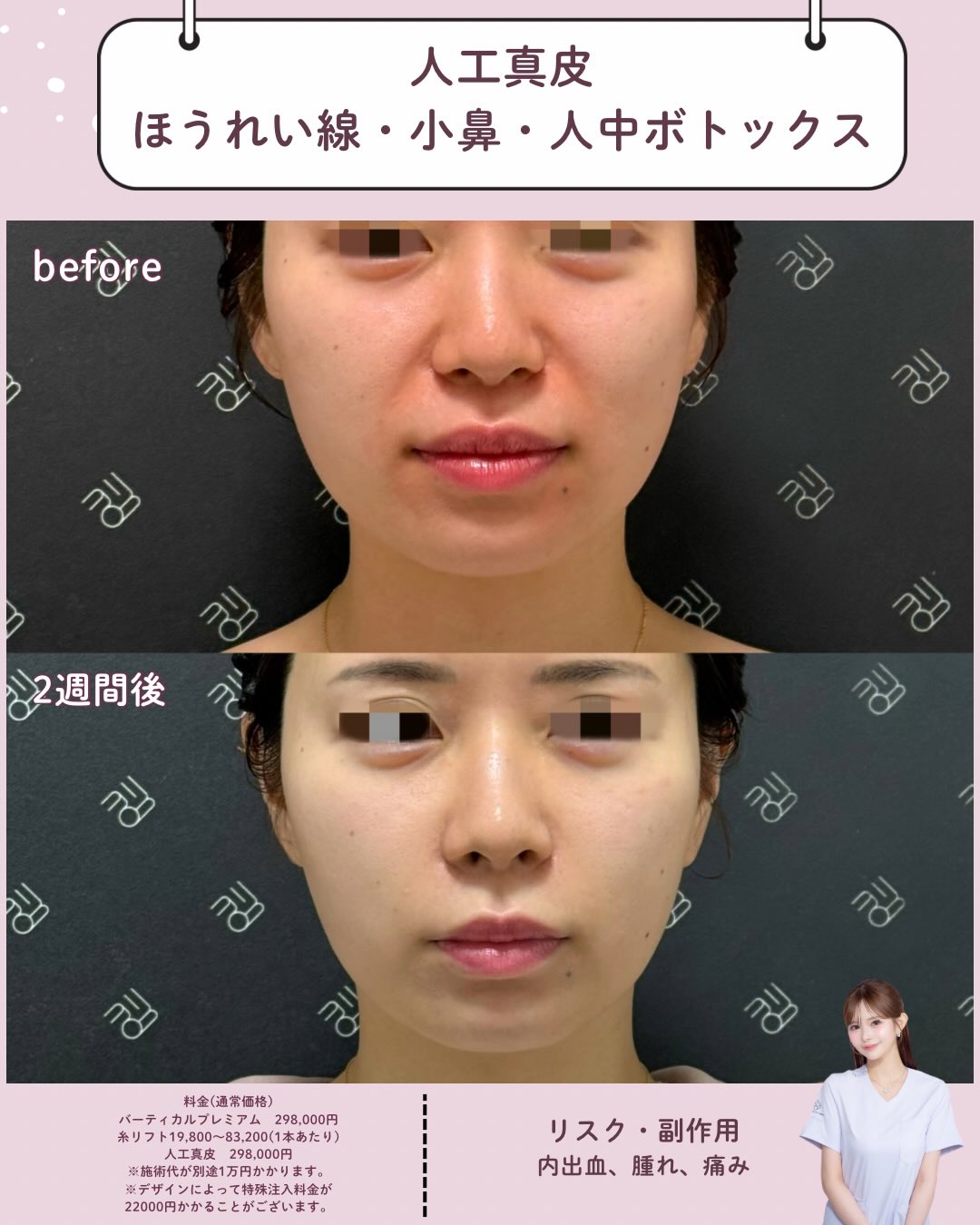 人工真皮×ボトックス