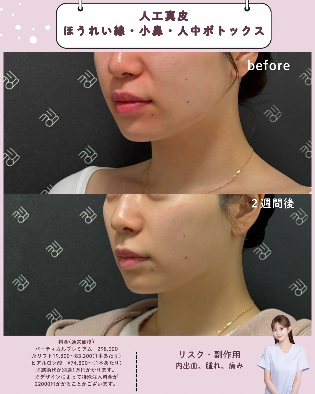 人工真皮×ボトックス