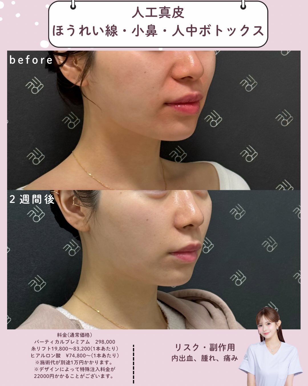 人工真皮×ボトックス