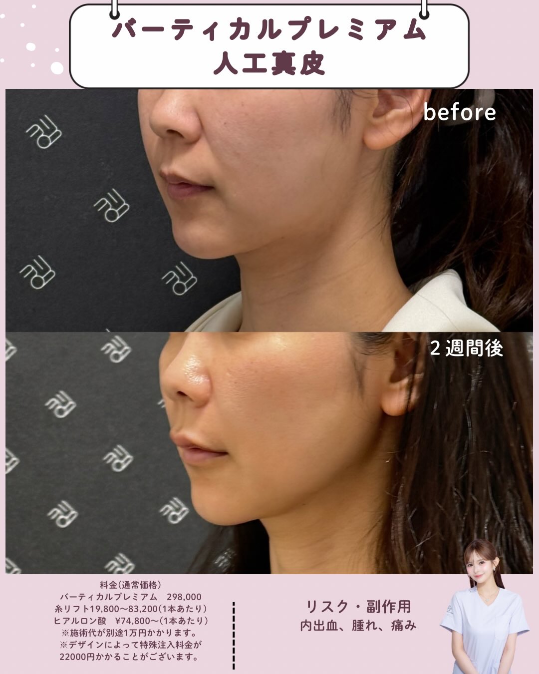 バーティカルリフト×人工真皮