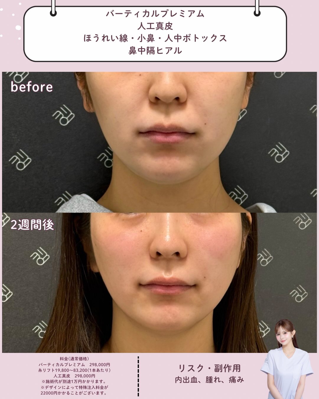 バーティカルリフトプレミアム×人工真皮