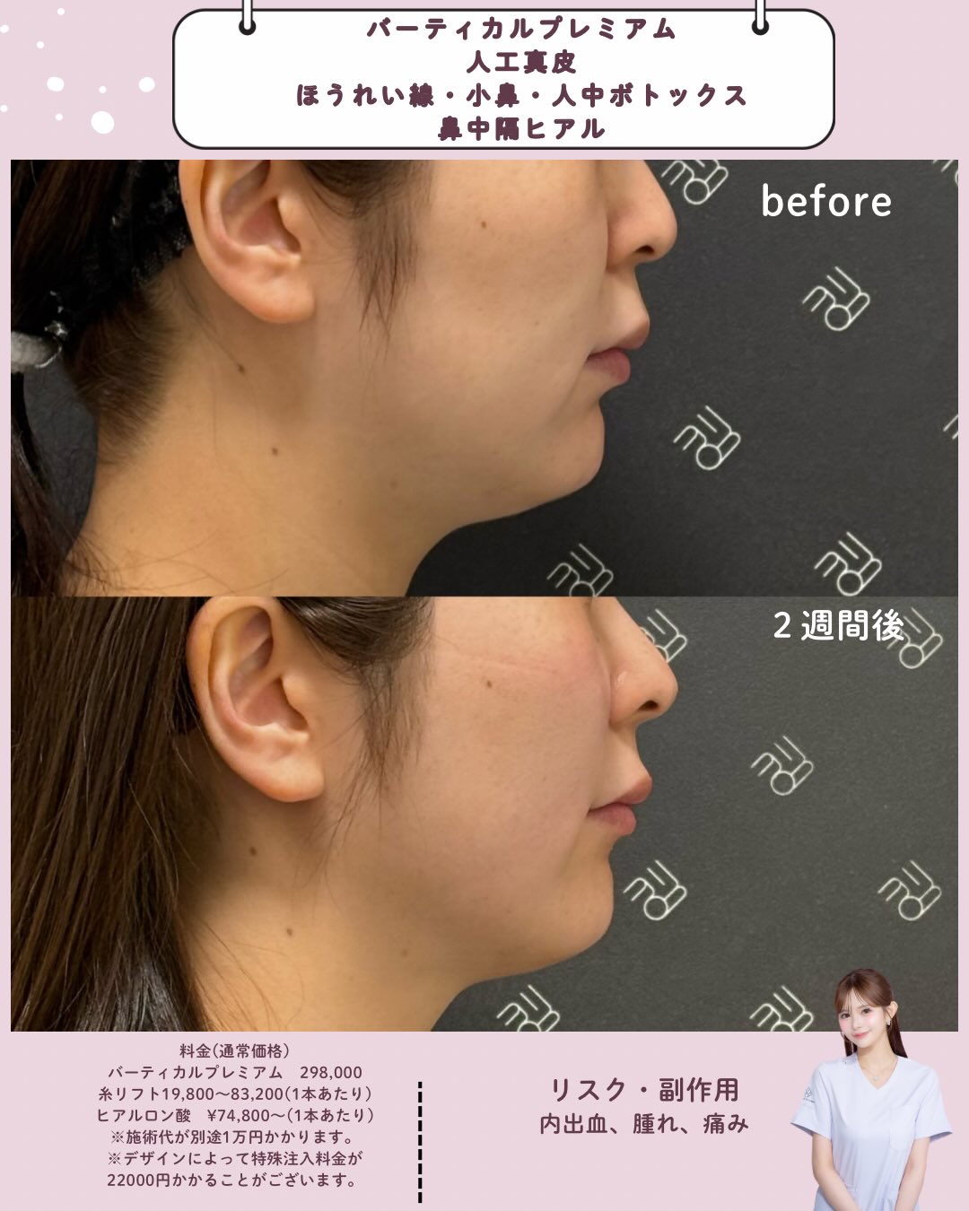 バーティカルリフトプレミアム×人工真皮