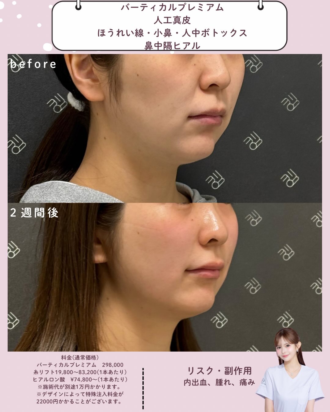 バーティカルリフトプレミアム×人工真皮