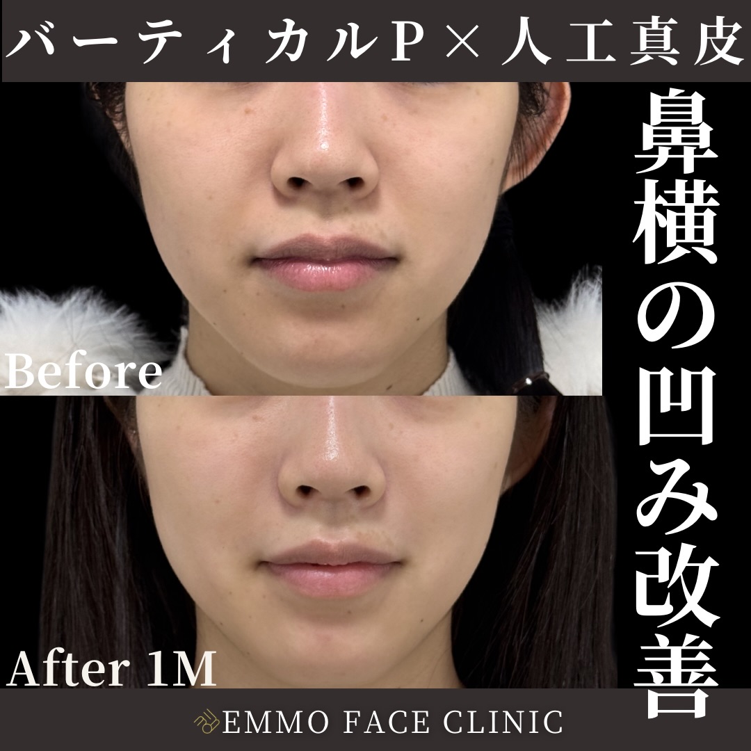 バーティカルリフトプレミアム×人工真皮