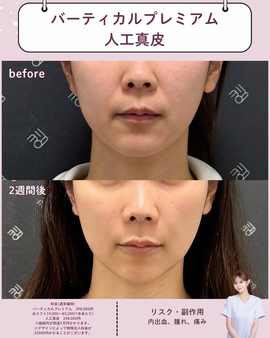 バーティカルリフト×人工真皮