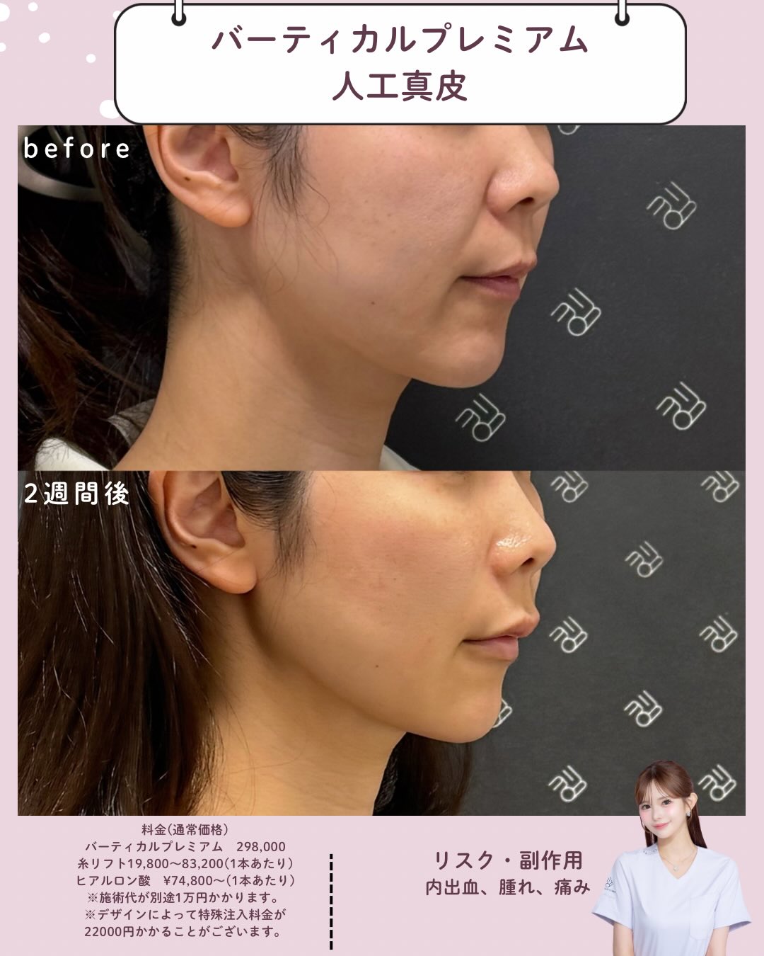 バーティカルリフト×人工真皮