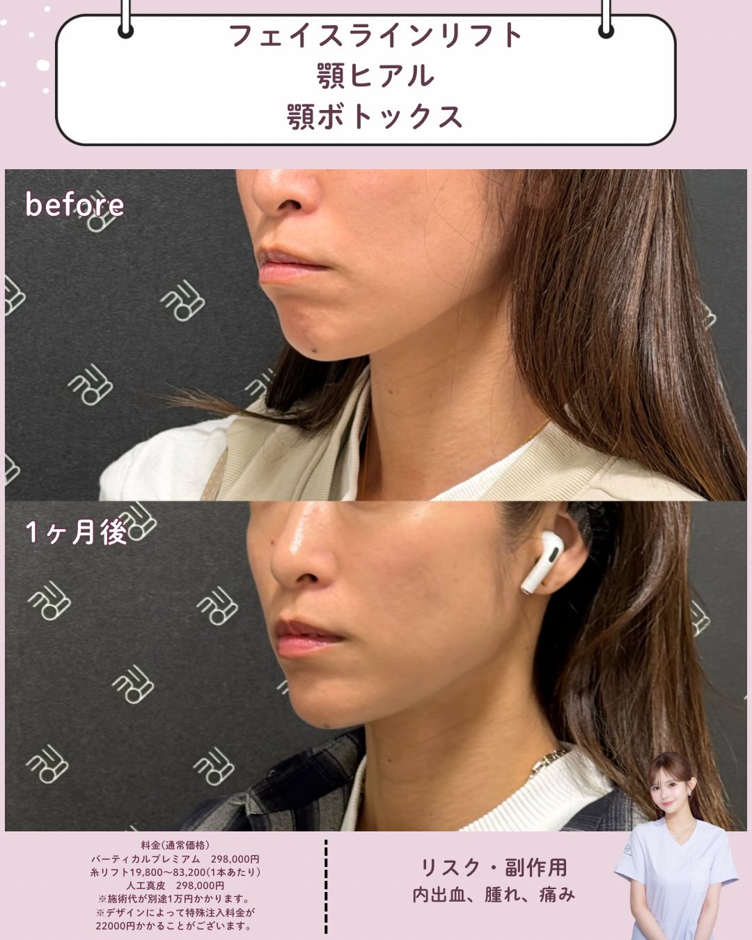 フェイスラインリフト×ヒアルロン酸×ボトックス