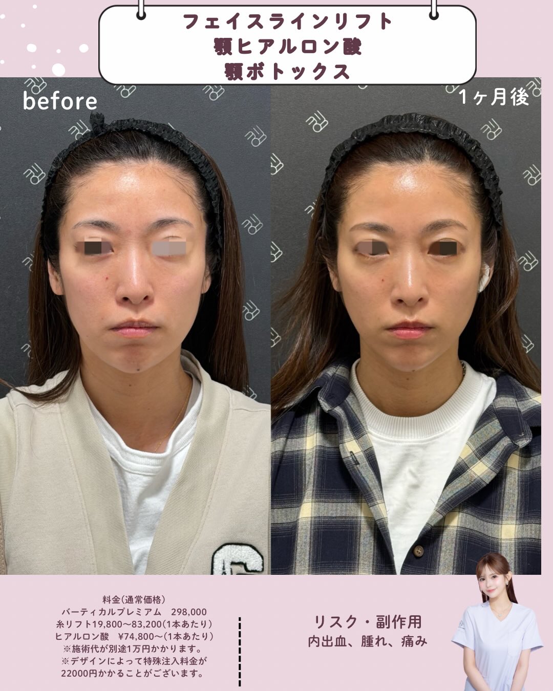 フェイスラインリフト×ヒアルロン酸×ボトックス