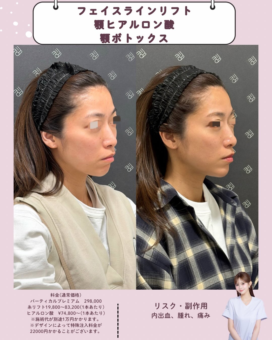 フェイスラインリフト×ヒアルロン酸×ボトックス