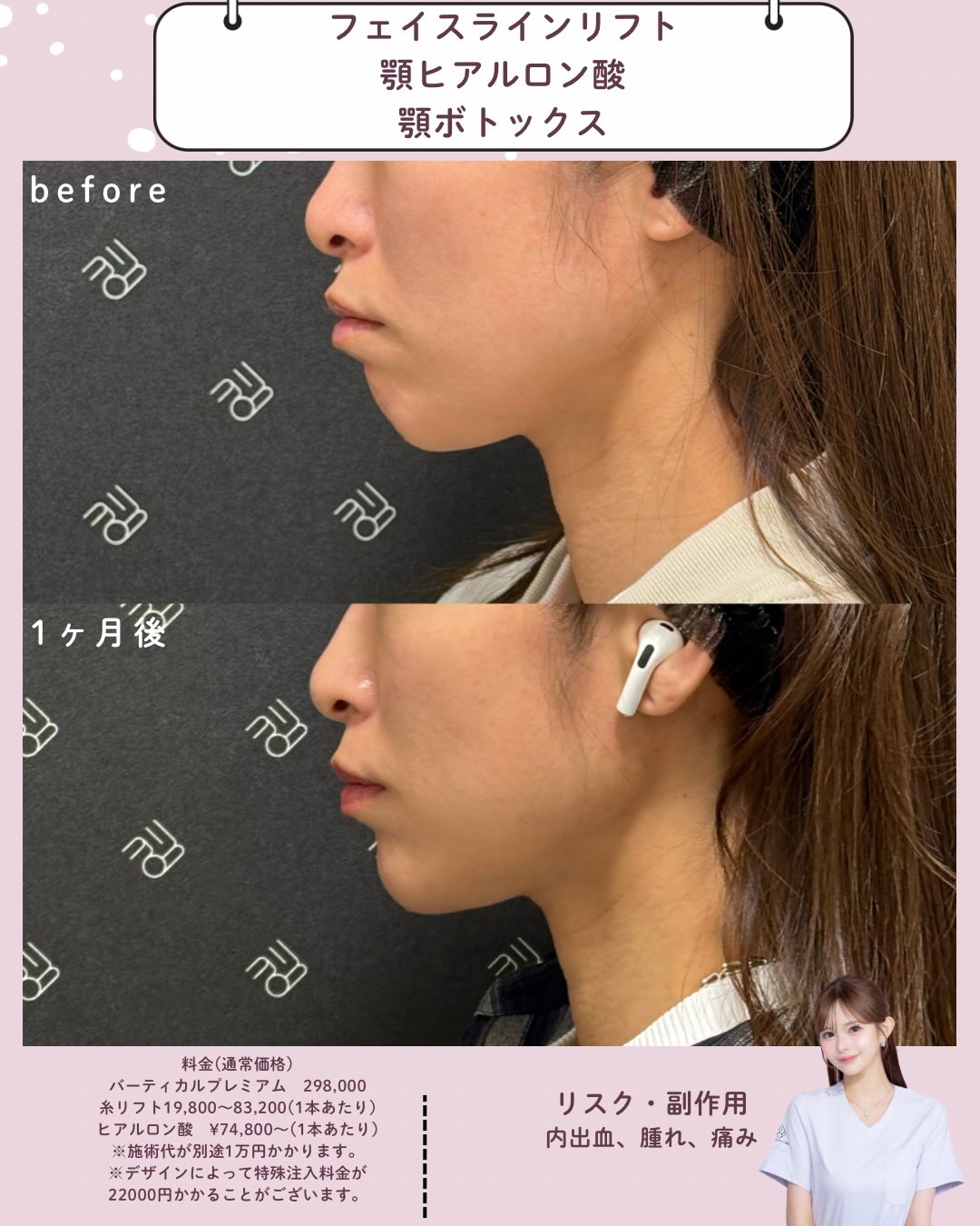 フェイスラインリフト×ヒアルロン酸×ボトックス