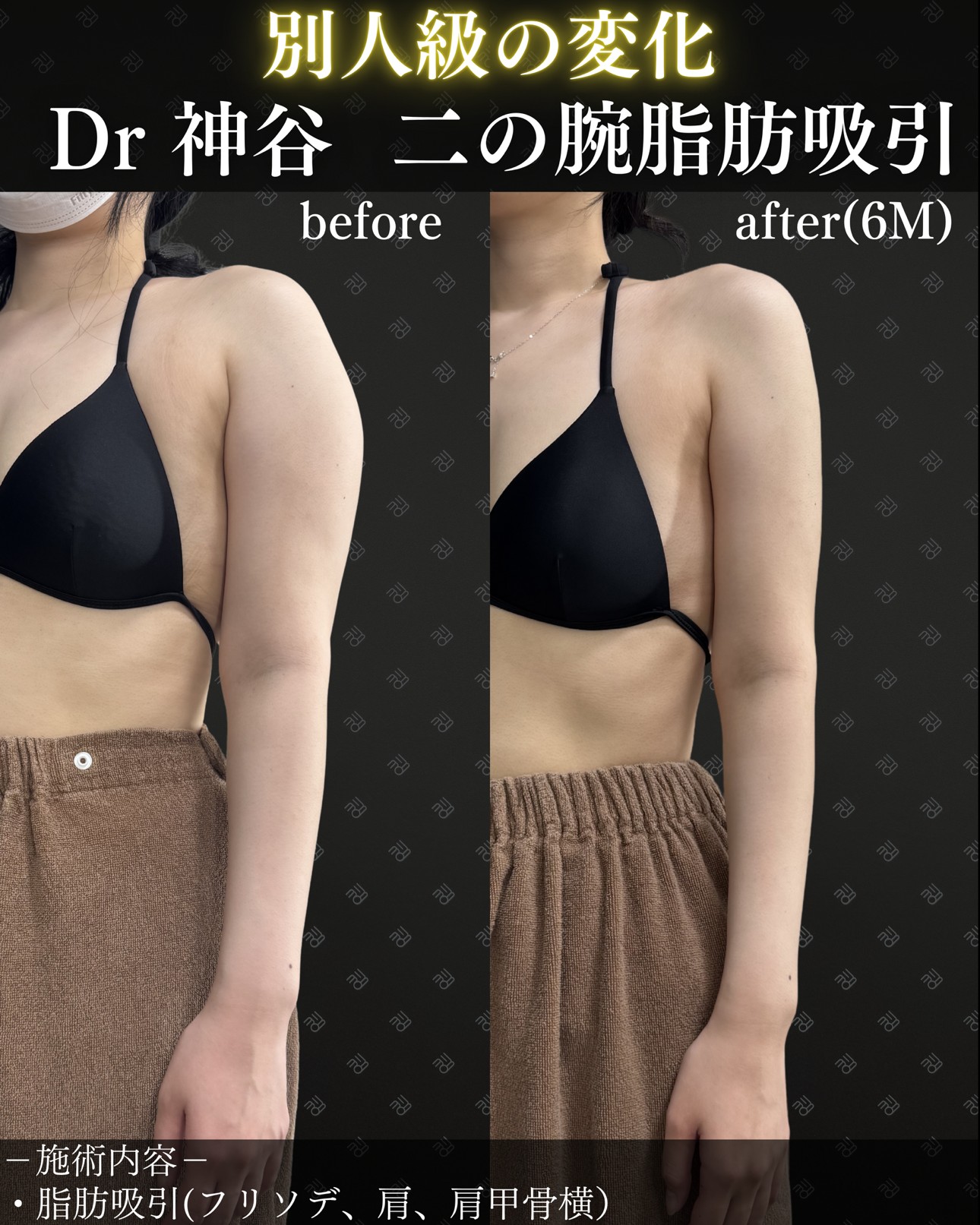 二の腕脂肪吸引ー症例写真