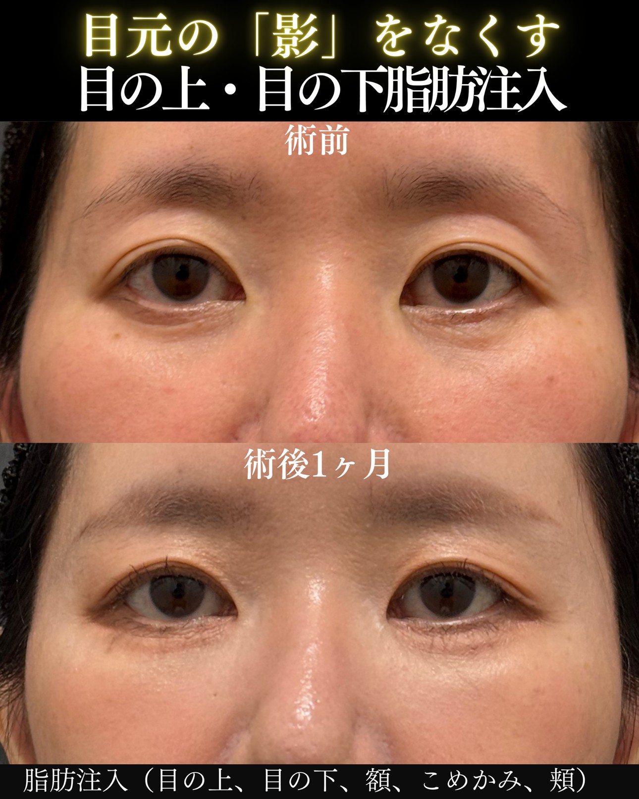 脂肪注入ー症例写真