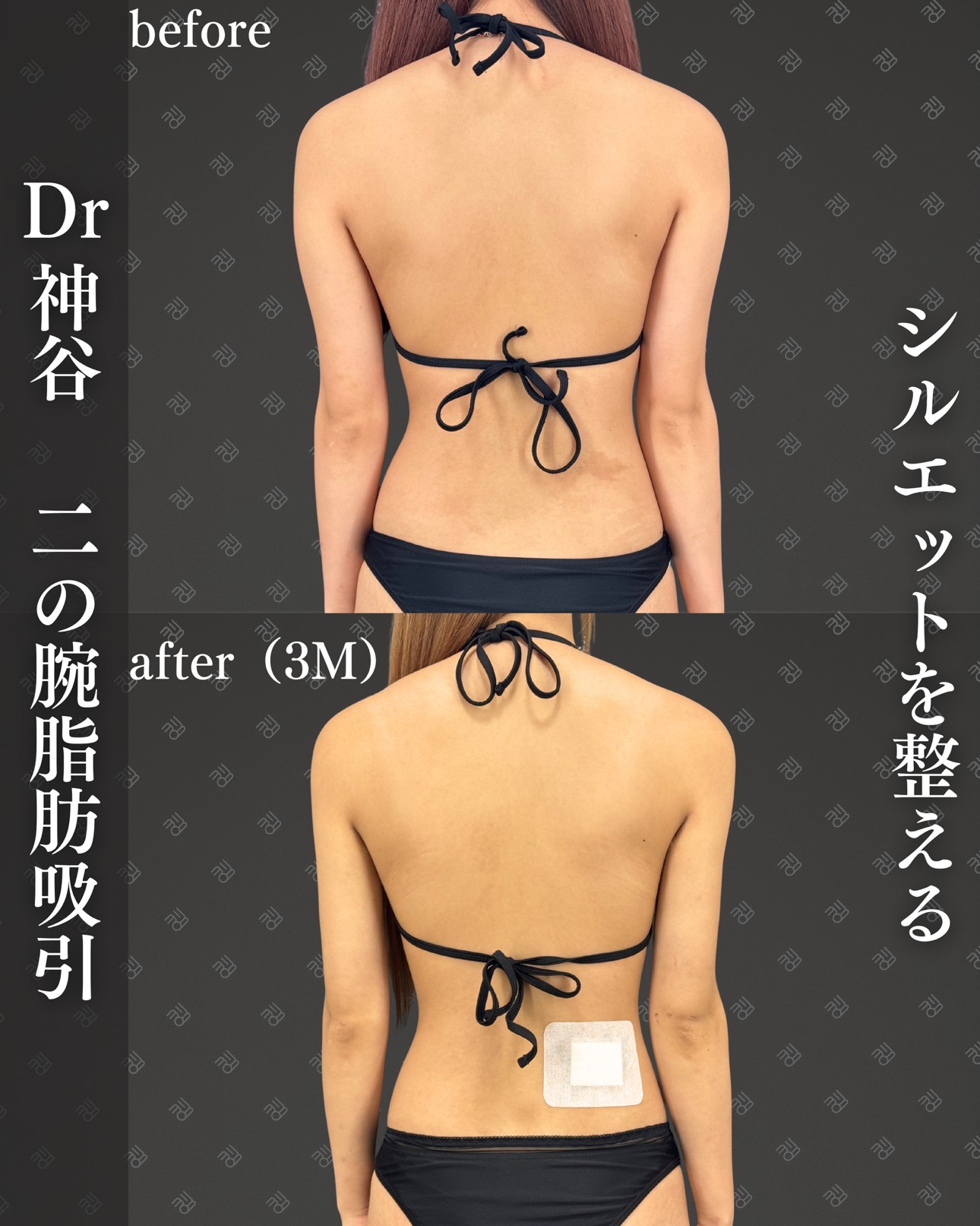 二の腕脂肪吸引ー症例写真