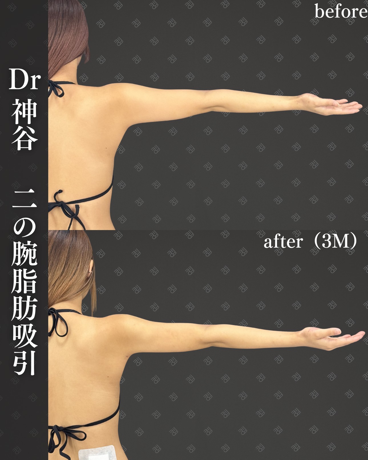 二の腕脂肪吸引ー症例写真