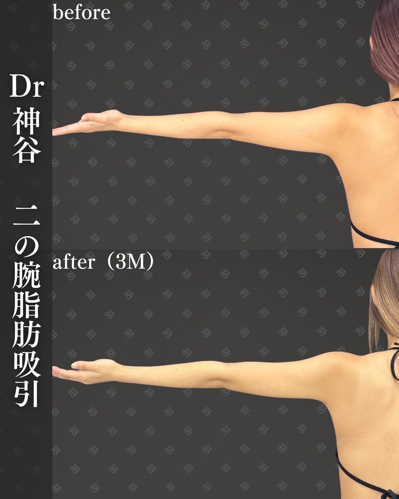 二の腕脂肪吸引ー症例写真