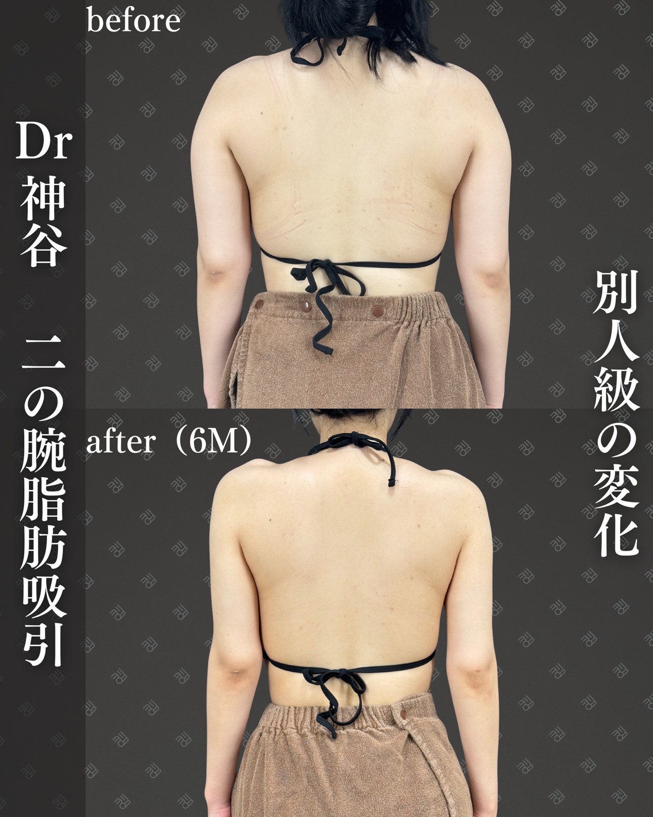 二の腕脂肪吸引ー症例写真