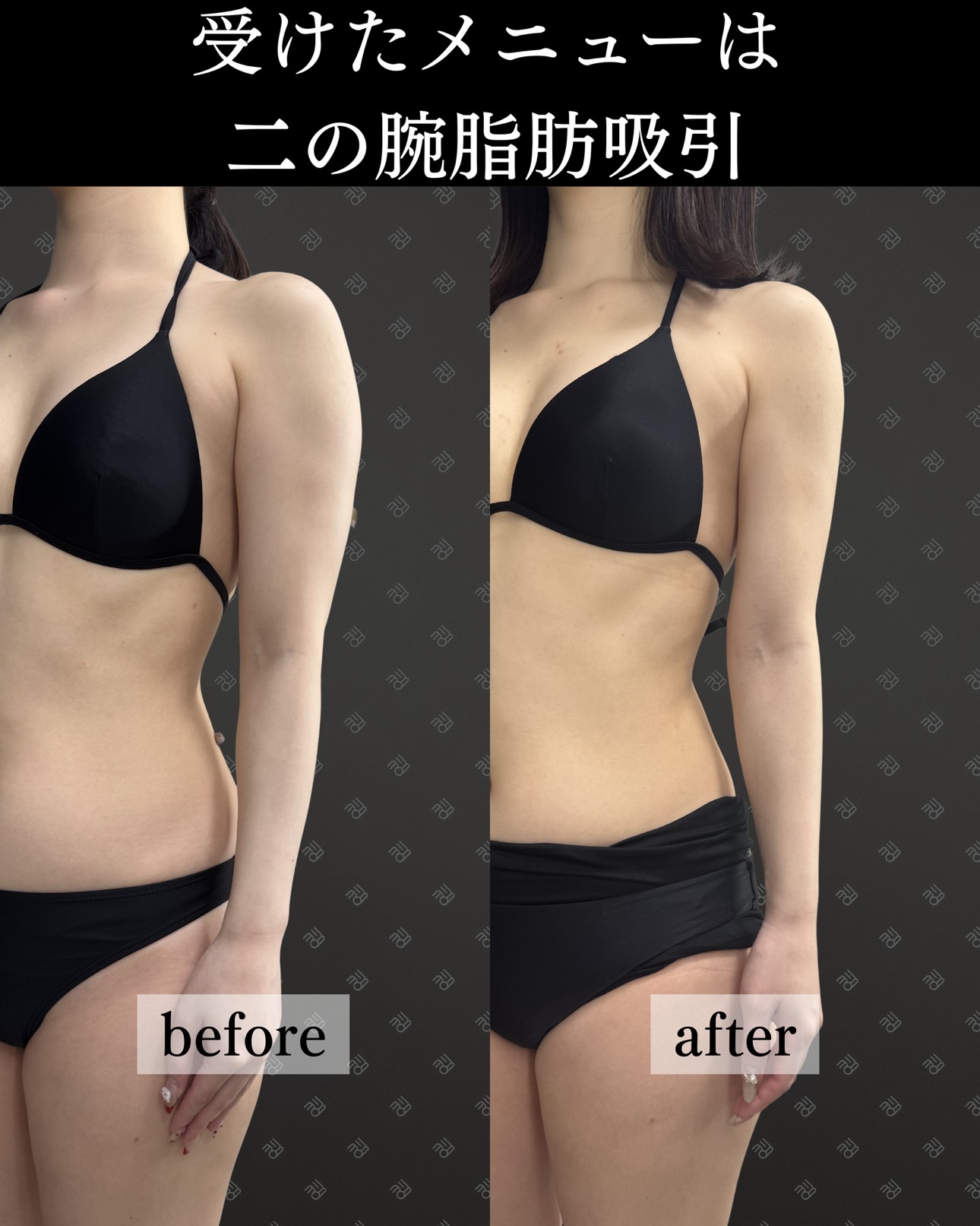 二の腕脂肪吸引ー症例写真