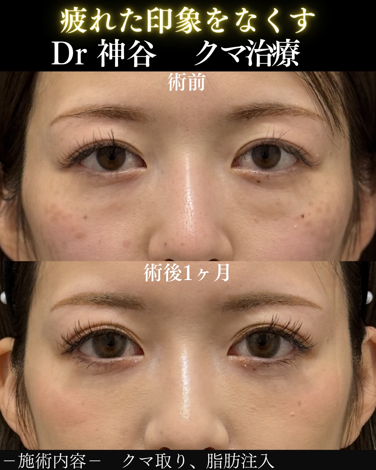 クマ取りー症例写真