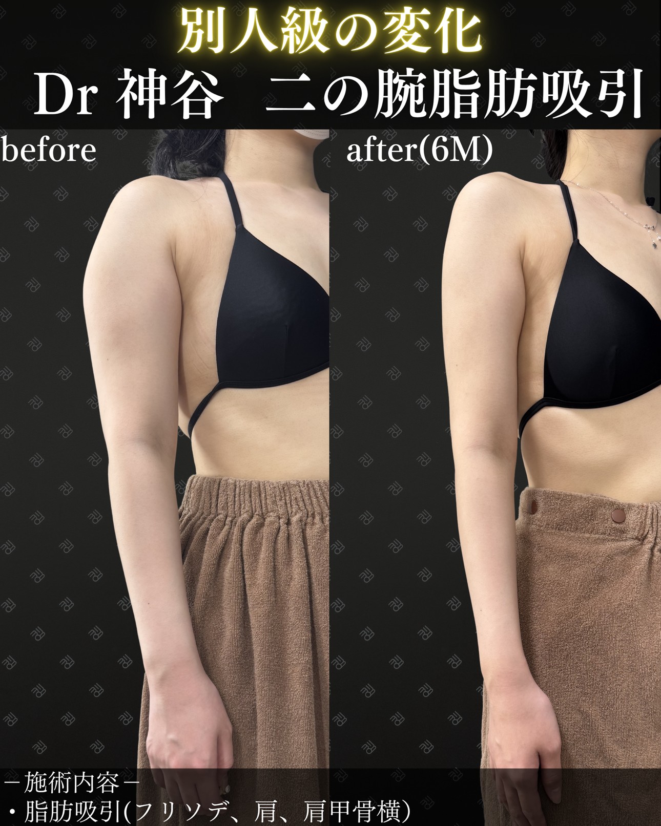 二の腕脂肪吸引ー症例写真