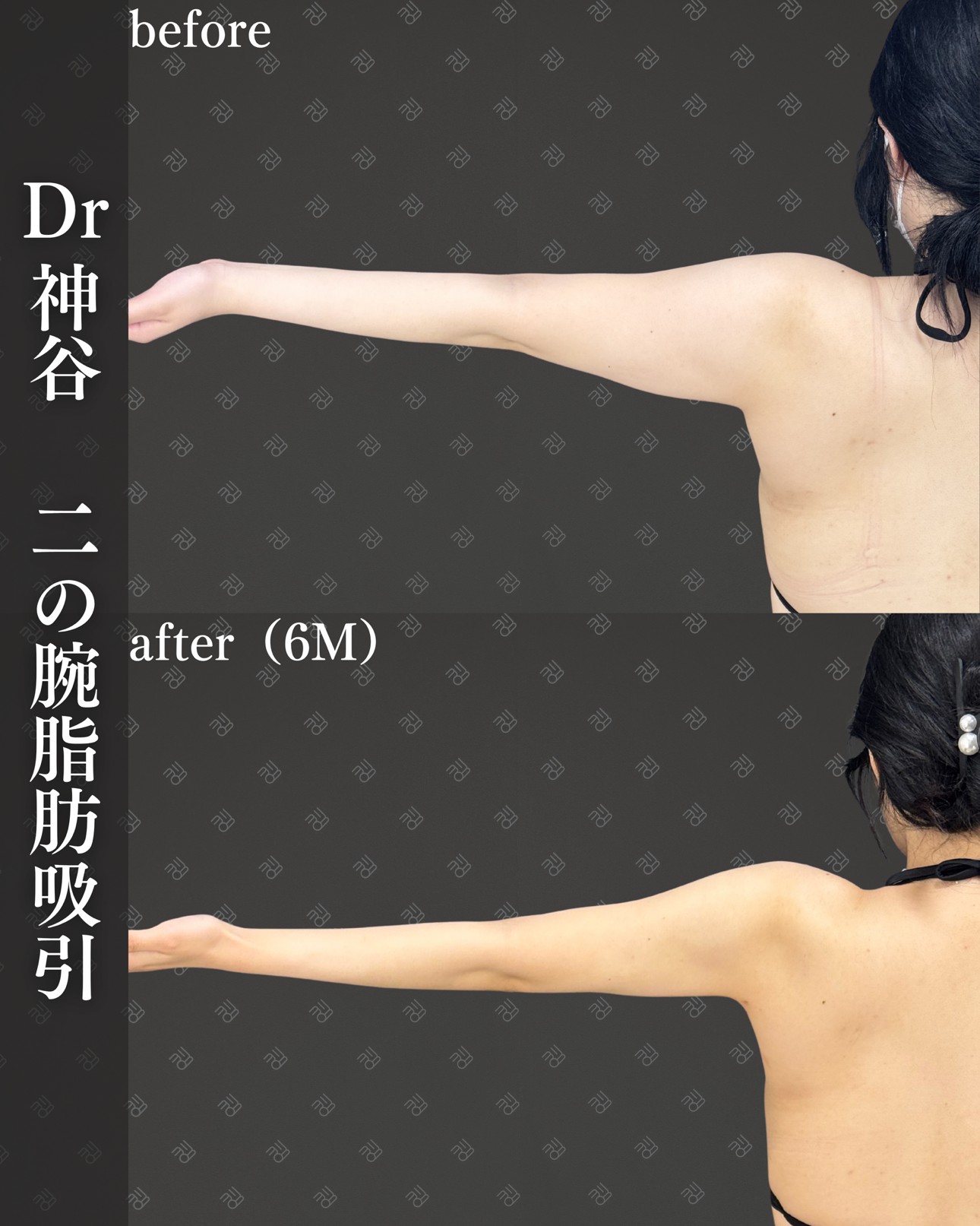 二の腕脂肪吸引ー症例写真