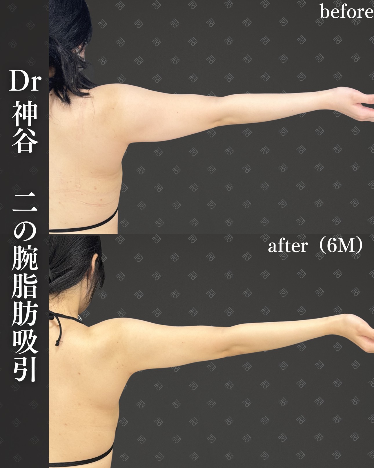 二の腕脂肪吸引ー症例写真