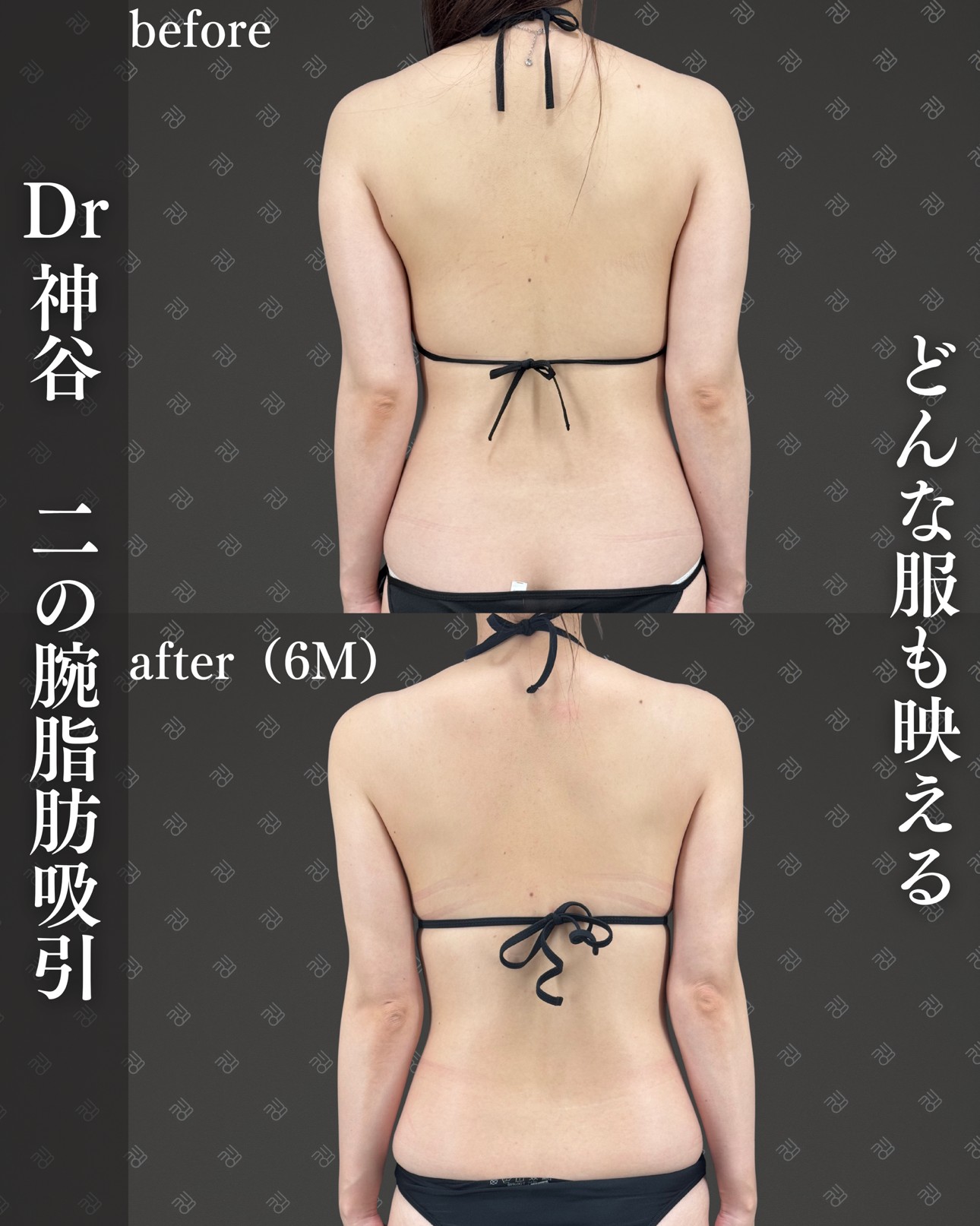 二の腕脂肪吸引ー症例写真