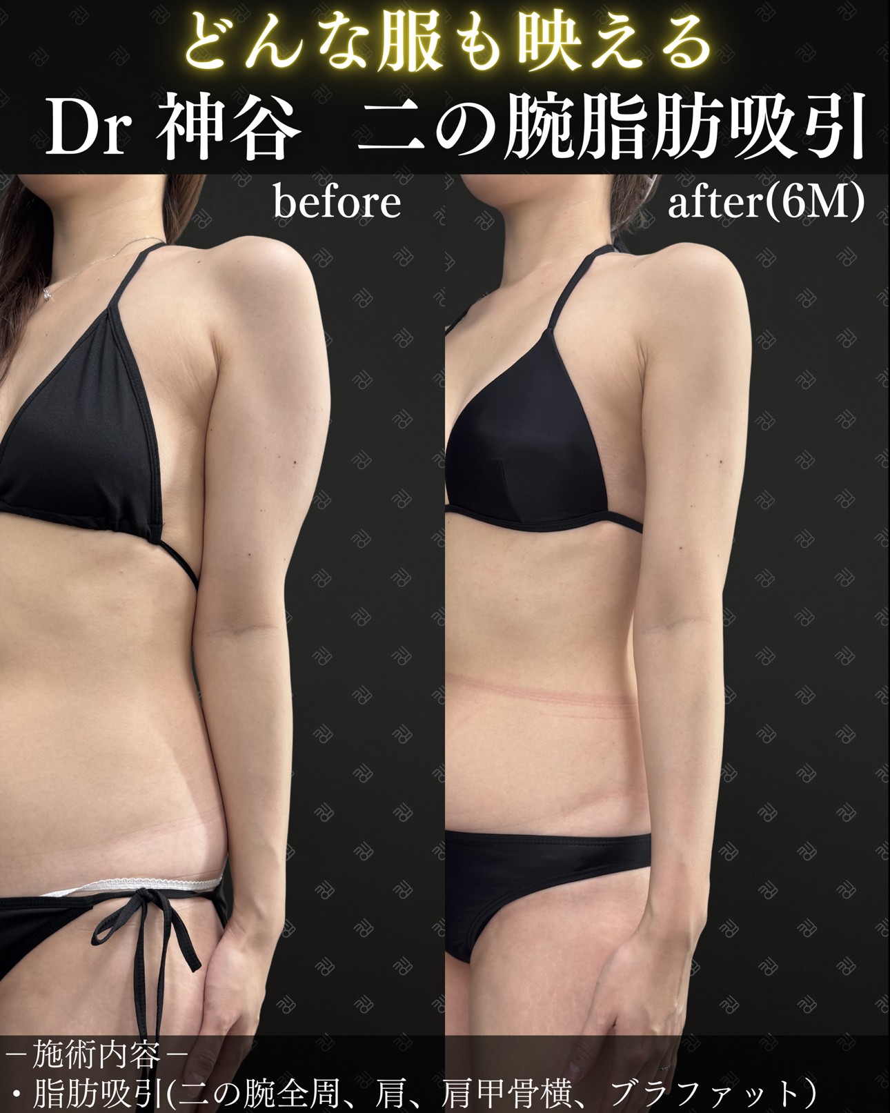 二の腕脂肪吸引ー症例写真