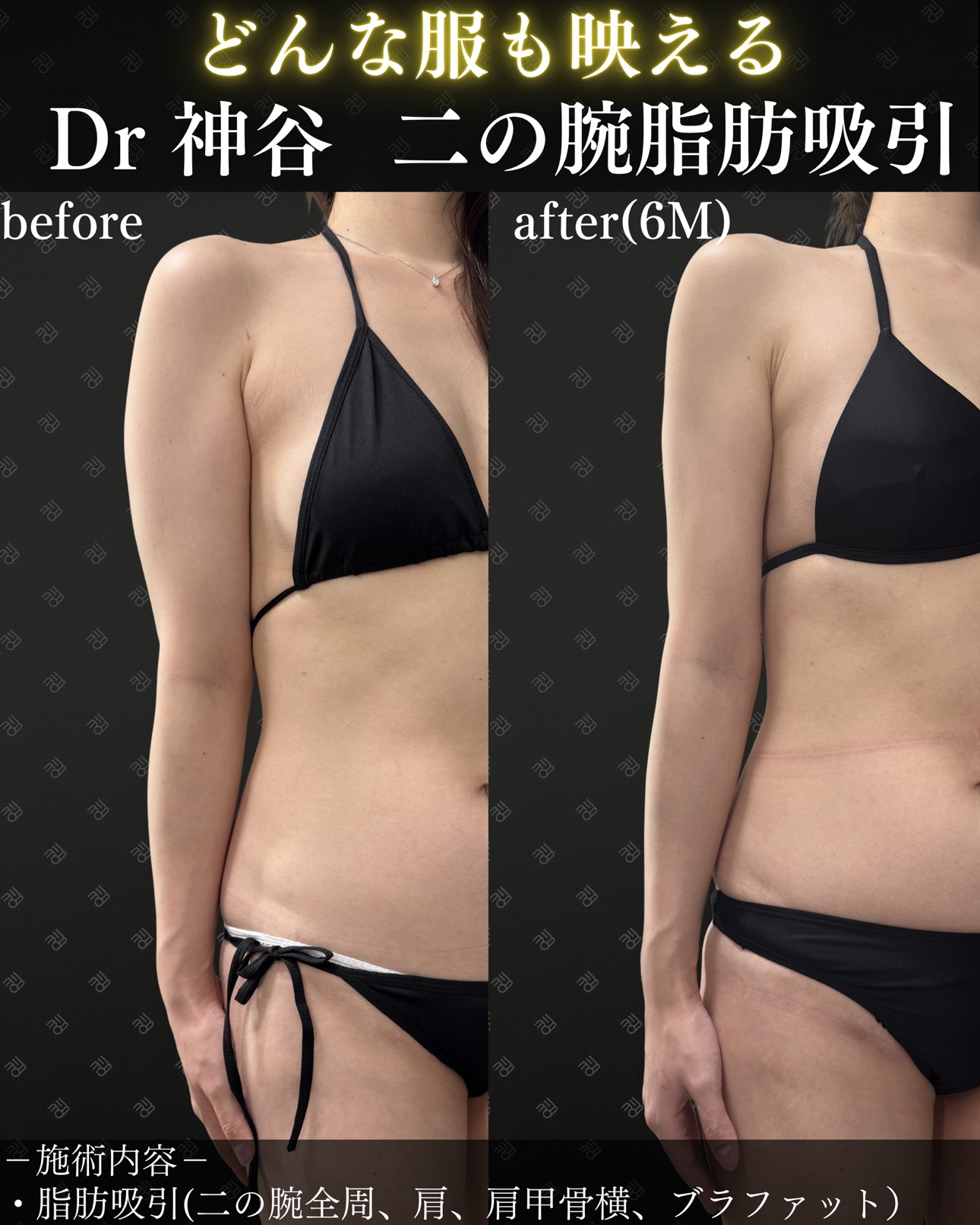 二の腕脂肪吸引ー症例写真