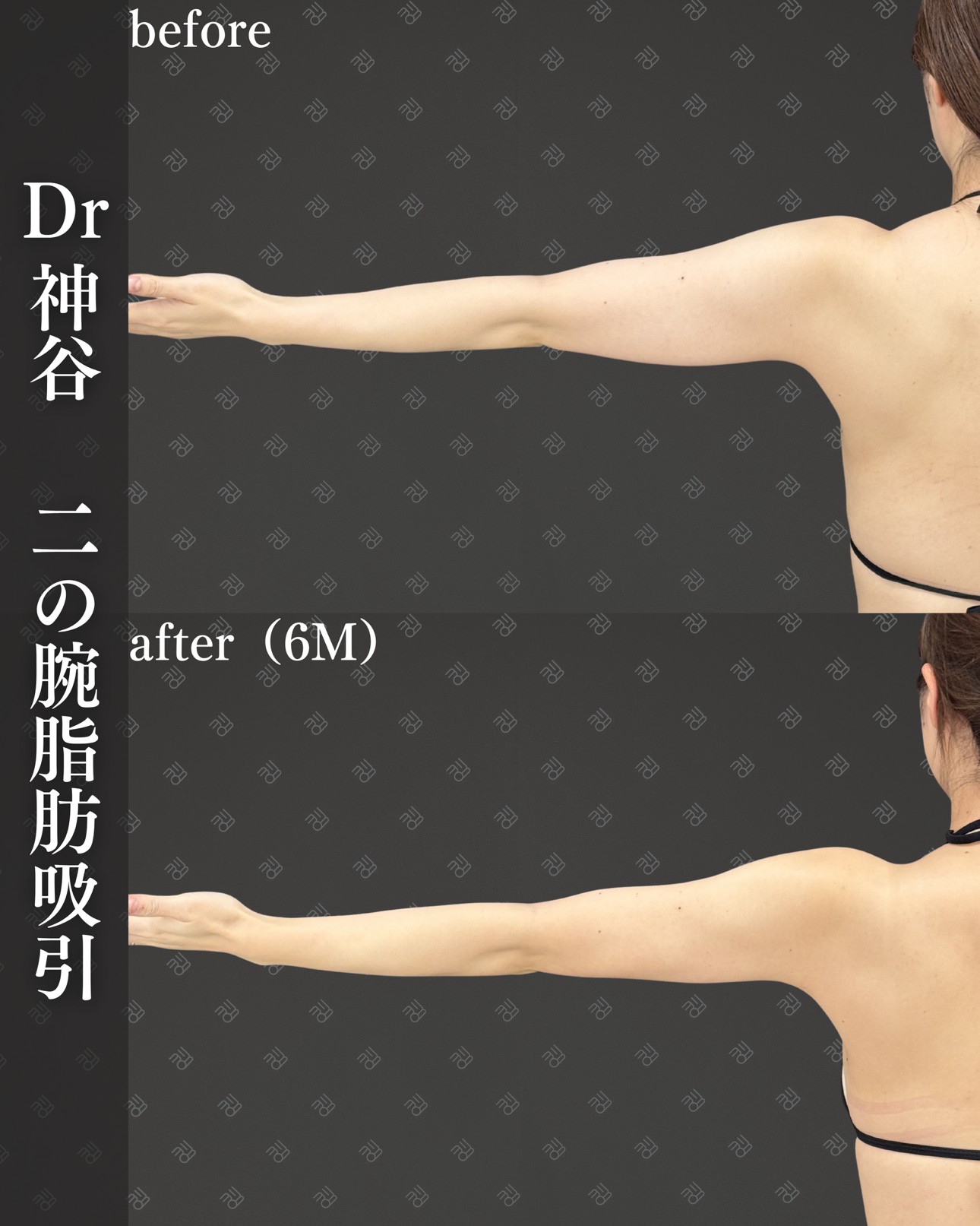 二の腕脂肪吸引ー症例写真