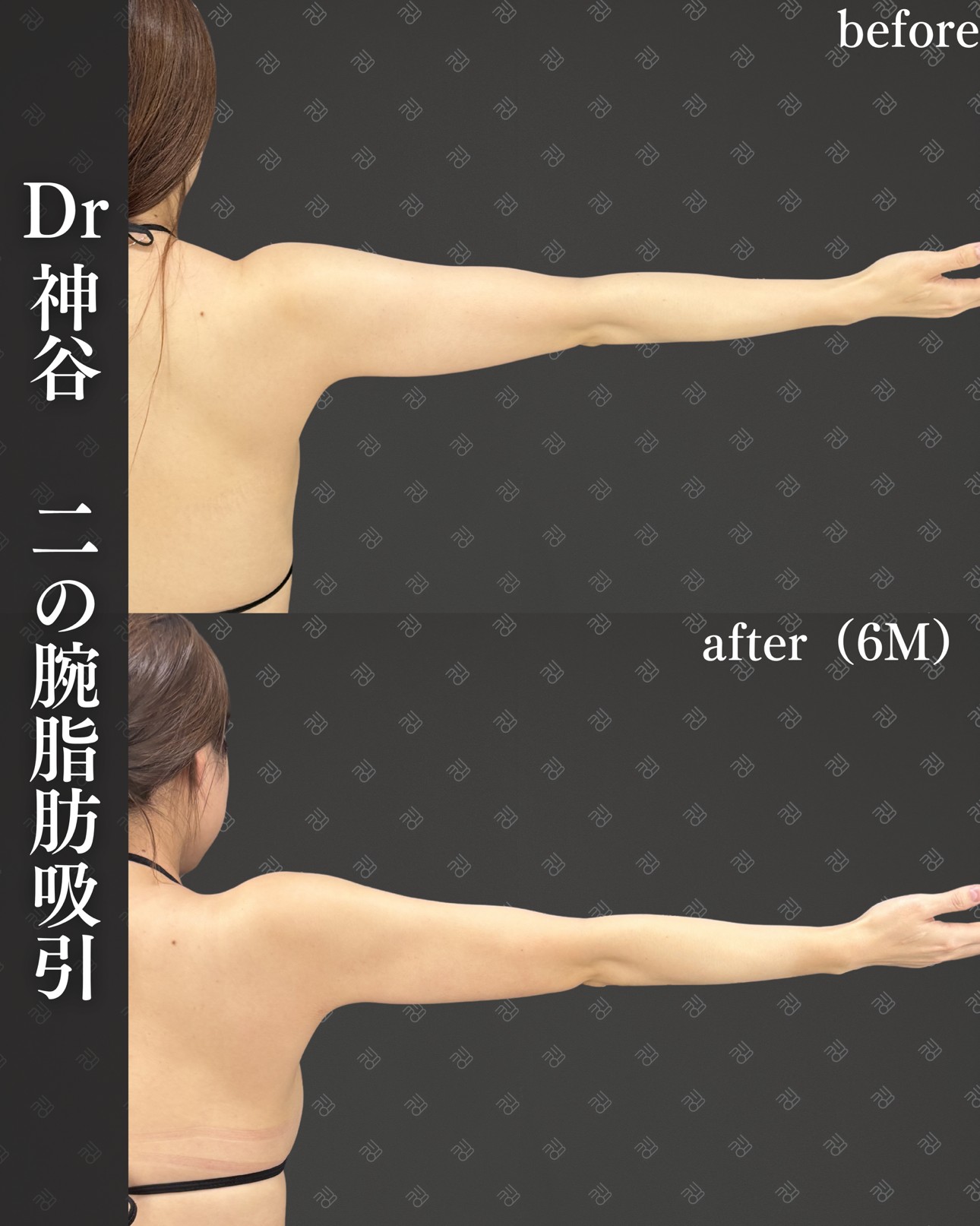 二の腕脂肪吸引ー症例写真