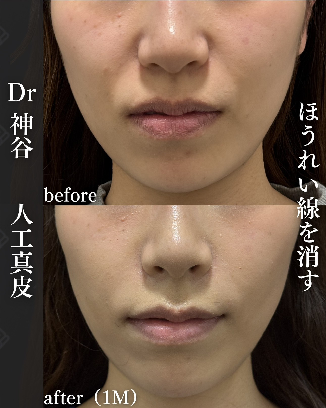 人工真皮ー症例写真